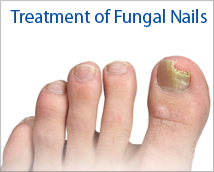 Treatment of Fungal Nails