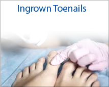 Ingrown Tonails